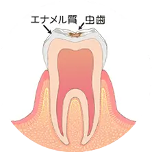 歯の表層（エナメル質）の虫歯