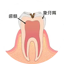 歯の中（象牙質）の虫歯