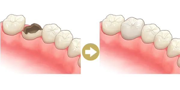 ぶせ物（クラウン）を装着
