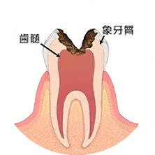 神経まで達した虫歯