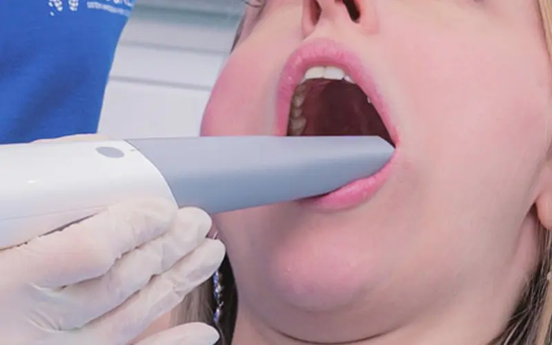 型取りの不快感の軽減