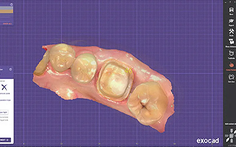 最短手術当日に自然な補綴まで