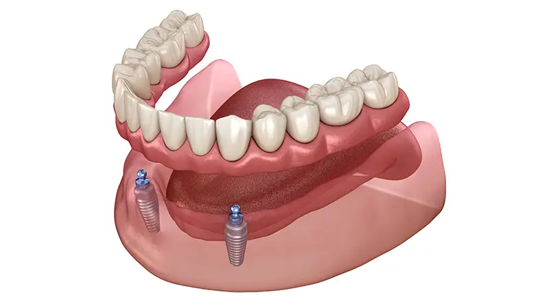 インプラントオーバーデンチャー