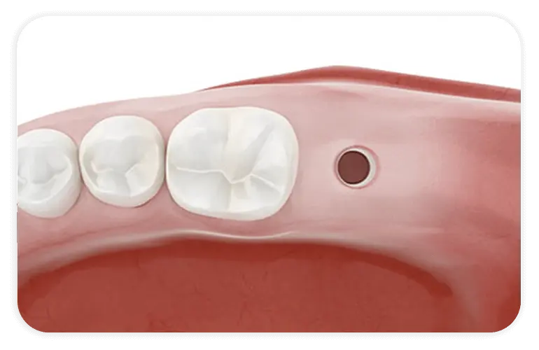 痛みを減らし回復は早く