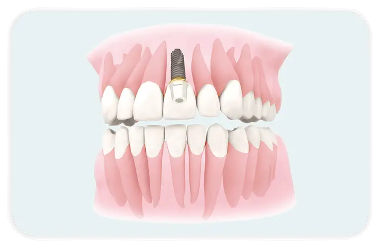 最短手術当日に自然な補綴まで
