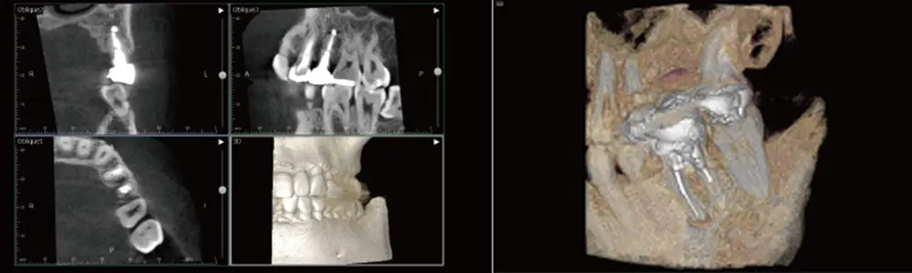 歯科用CT・デジタルレントゲン