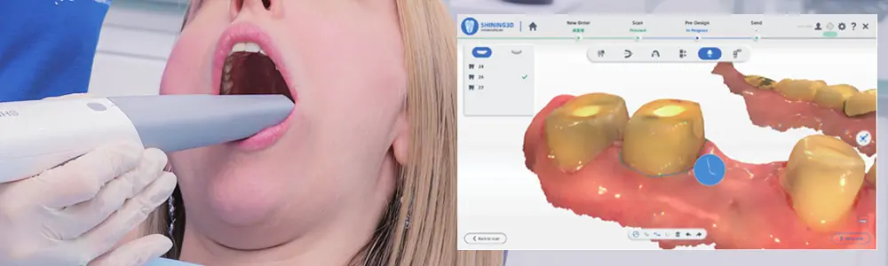 口腔内スキャナー