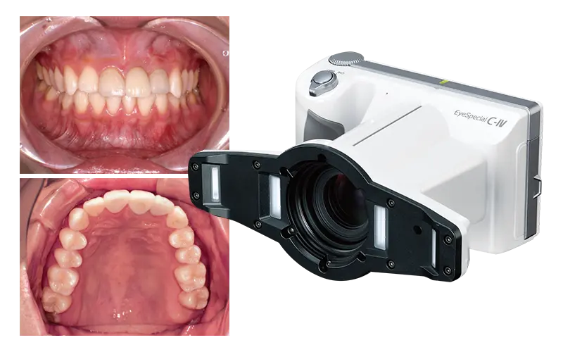 口腔内カメラ