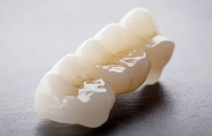 セラミック治療