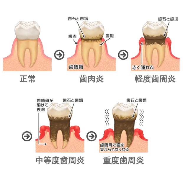歯周病