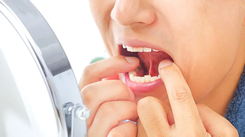 お口の中のできもの